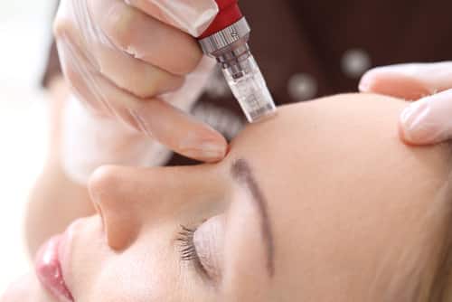 Microneedling-un-soin-a-la-pointe-Imaderm-Geneve