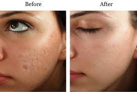 microneedling1